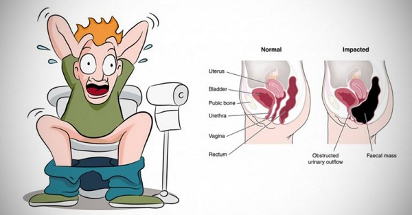 Nguyên nhân dẫn đến bệnh táo bón kéo dài