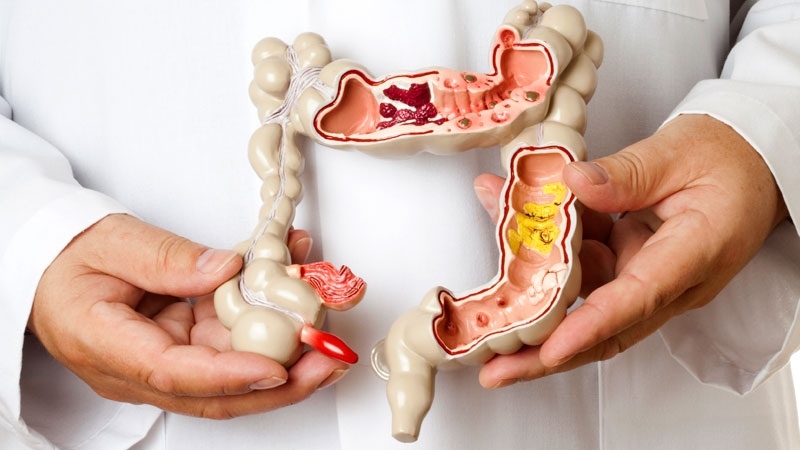Vai trò của tinh bột kháng trong điều trị chứng rối loạn tiêu hoá Vai trò của tinh bột kháng trong điều trị chứng rối loạn tiêu hoá