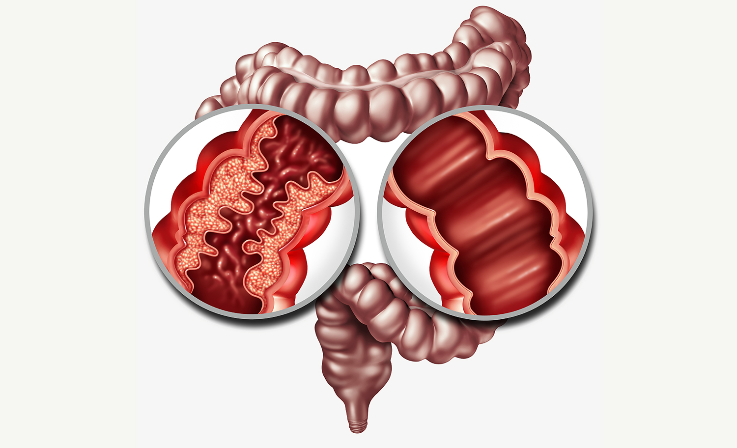 Thay đổi chế độ ăn uống đóng vai trò quan trọng trong việc kiểm soát bệnh Crohn và kéo dài thời gian giữa các cơn bùng phát. Thay đổi chế độ ăn uống đóng vai trò quan trọng trong việc kiểm soát bệnh Crohn và kéo dài thời gian giữa các cơn bùng phát.
