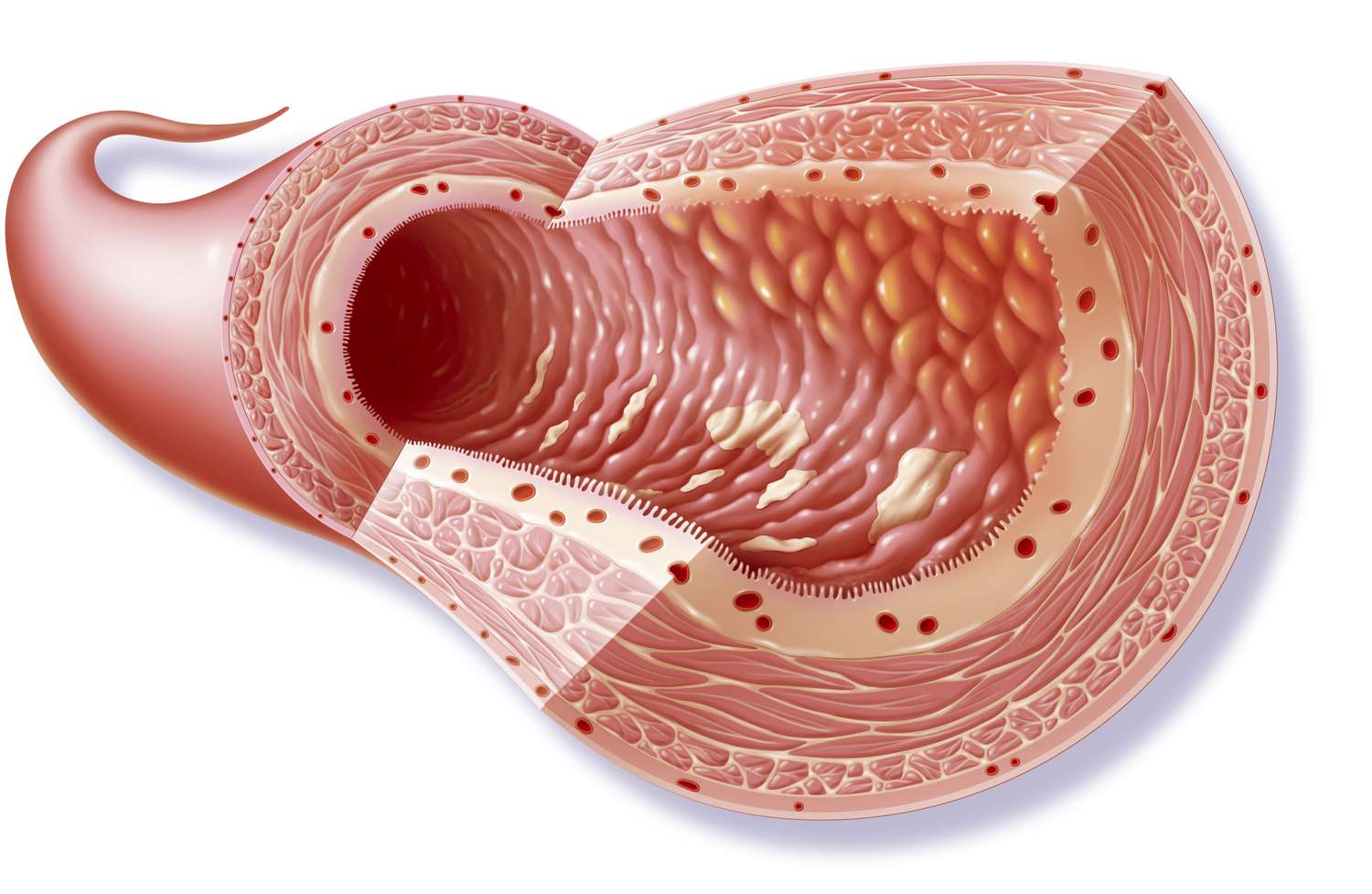 Bệnh Crohn ảnh hưởng đến cả hồi tràng và ruột kết. Bệnh Crohn ảnh hưởng đến cả hồi tràng và ruột kết.