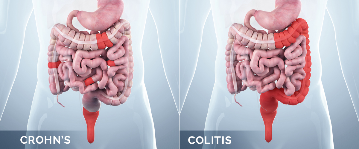 Mỗi vị trí khác nhau của bệnh Crohn sẽ có những triệu chứng đặc thù riêng. Mỗi vị trí khác nhau của bệnh Crohn sẽ có những triệu chứng đặc thù riêng.